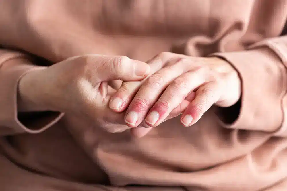 Ruky vložené v lone osoby, ktorá má oblečený svetlohnedý sveter, s viditeľnými prejavmi suchej a popraskanej kože na prstoch, čo sú typické znaky atopického ekzému.